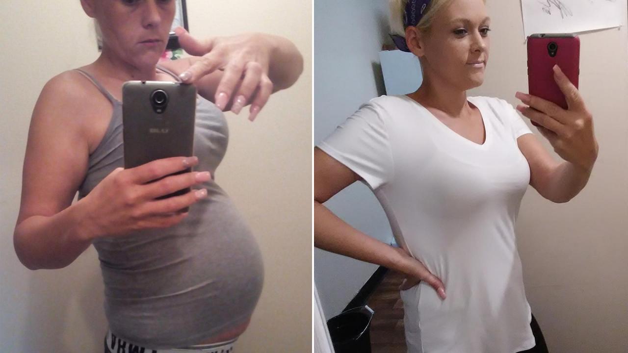 Ovarian Cyst Removal And Weight Loss